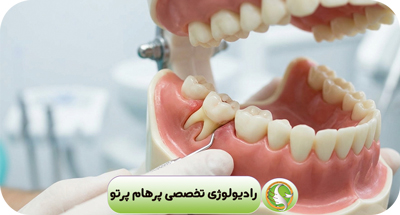نزدیکی دندان عقل به عصب فک چه خطراتی دارد؟ | نقش CBCT در جراحی ایمن
